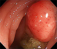 Polyp in the colon