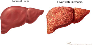 cirrhosis