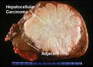 liver-cancer-1